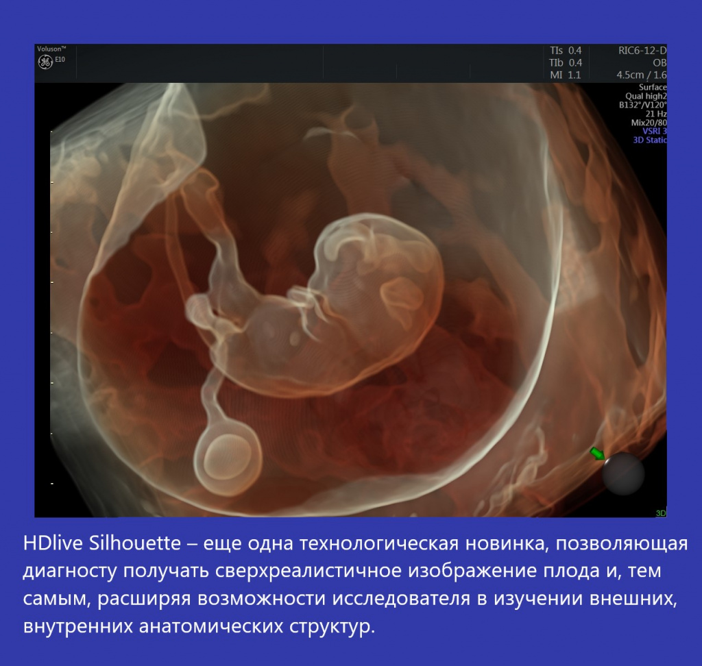 Технология HDlive Silhouette УЗИ-аппарата Voluson E10.jpg Технология HDlive Silhouette УЗИ-аппарата Voluson E10.jpg