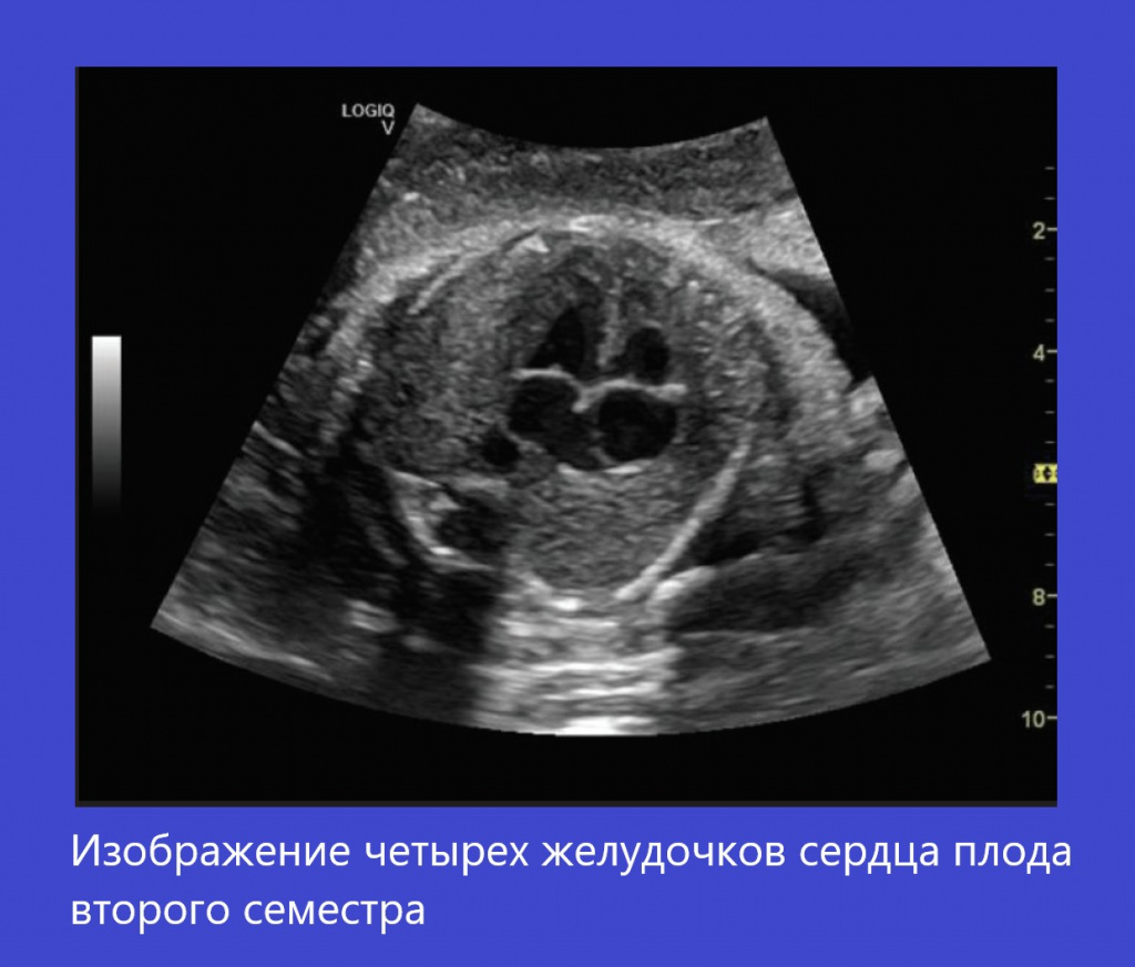 logiq_v5_chamber.jpg logiq_v5_chamber.jpg