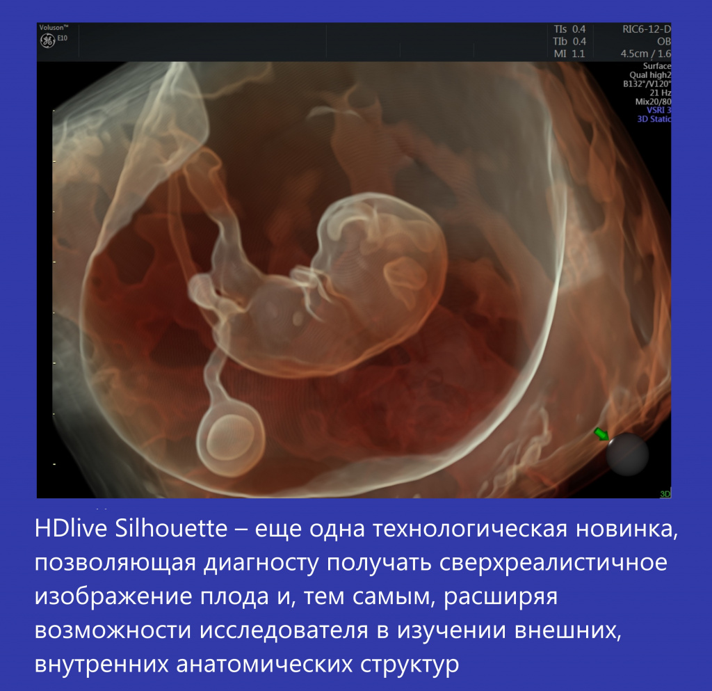 Voluson E10-1.jpg