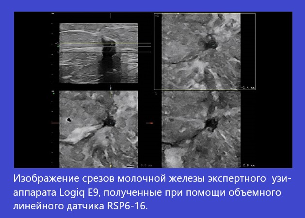 logiq-e9-breast.jpg