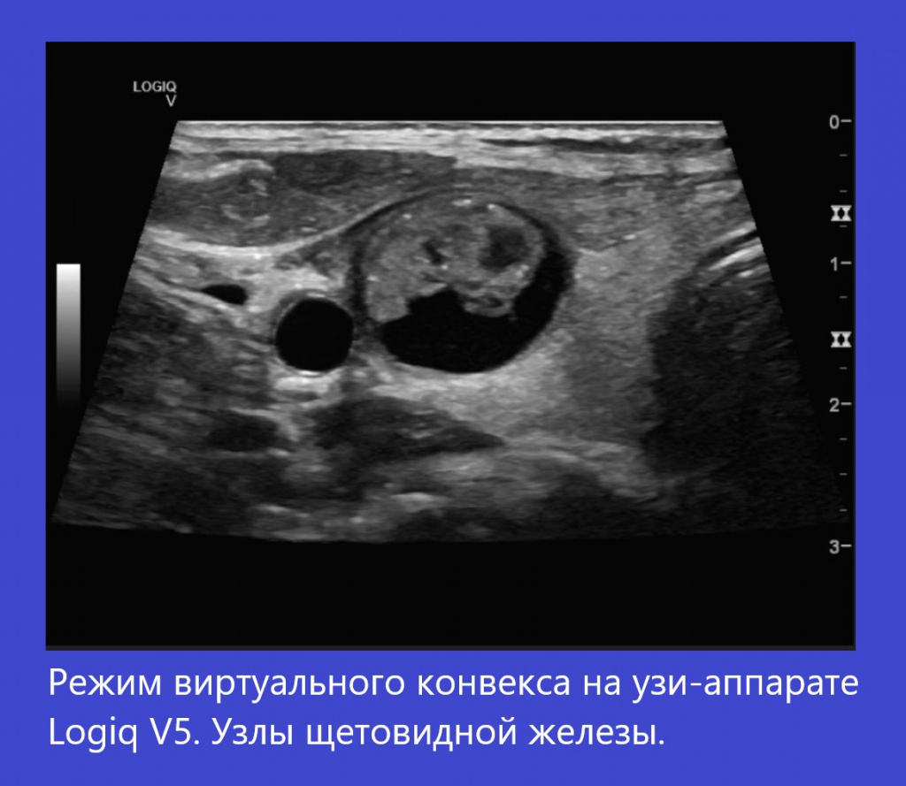 logiq_v5_virtual_convex.jpg logiq_v5_virtual_convex.jpg